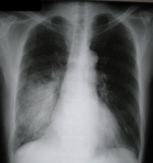 pneumonia-Community_acquired